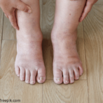 Diabetes swollen feet1